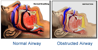 Normal and Obstructed Airway Graphic | Sleep Solutions San Antonio
